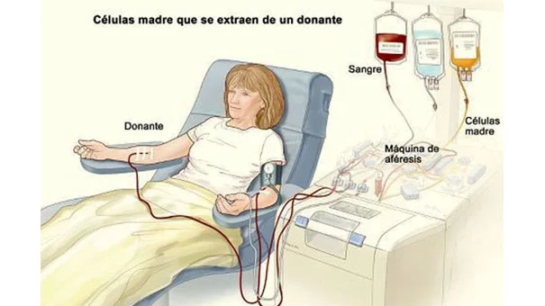 Donación de médula a traves de extracción de sangre periférica.
